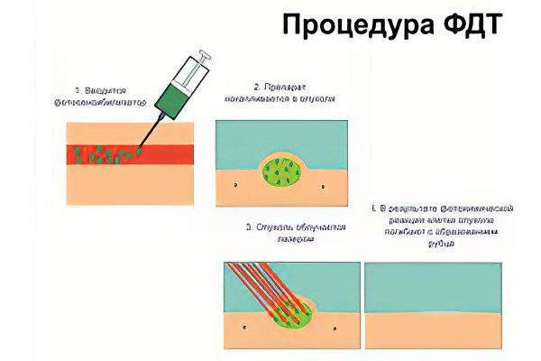 Photodynamic therapy of the cervix