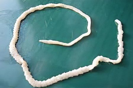 Pig tapeworm in humans