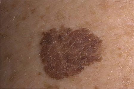 Pigmented nevus