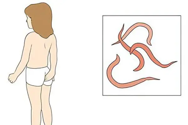 Pinworms in children: symptoms and treatment