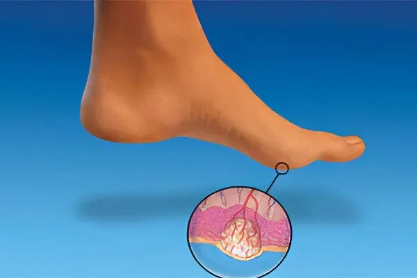 plantar warts