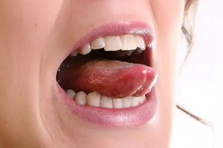 Plaque on the tongue in adults