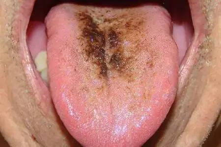 Plaque on the tongue in adults