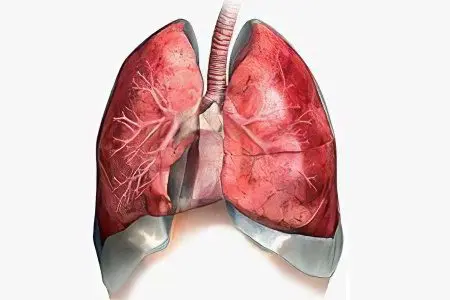 Pneumosclerosis of the lungs