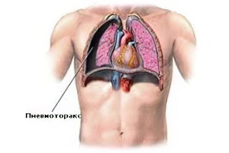 Pneumothorax of the lung