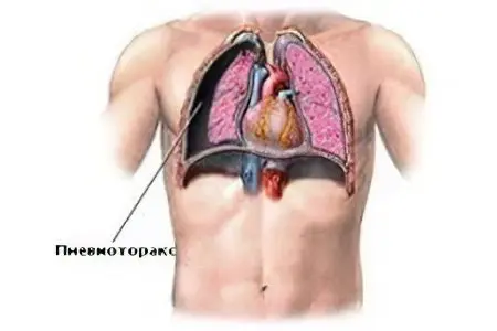 Pneumothorax of the lung