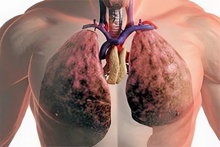 Pneumothorax of the lung