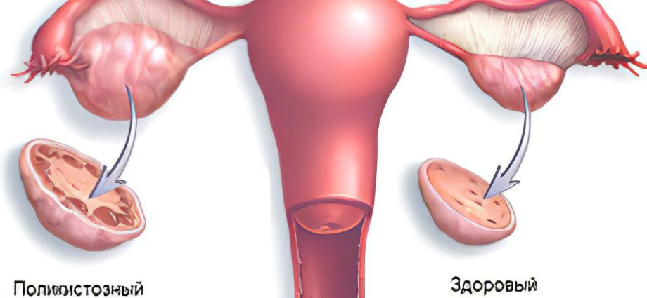 Polycystic ovaries: symptoms and treatment