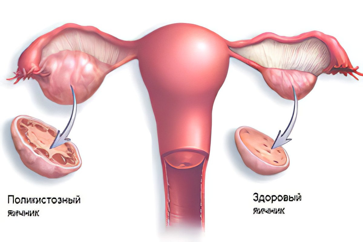 Polycystic ovaries: symptoms and treatment