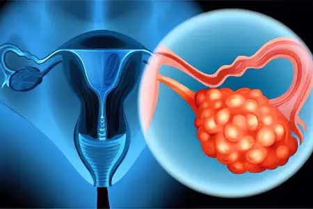 Polycystic ovaries: symptoms and treatment