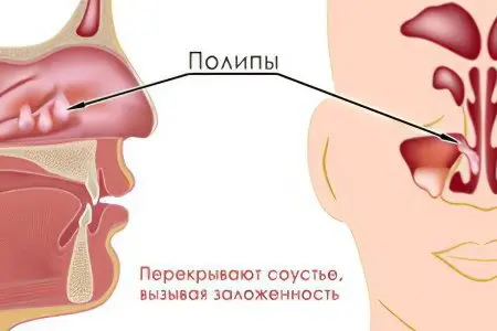 Polyposis sinusitis: treatment, causes and symptoms