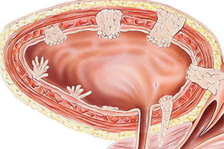 Polyps in the gallbladder &#8211; what to do?