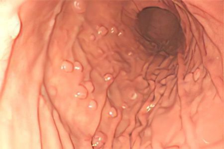 Polyps in the stomach - is it dangerous? How to treat?