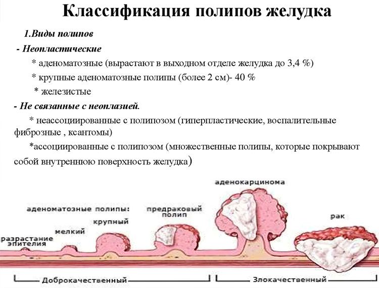 Polyps in the stomach - is it dangerous? How to treat?