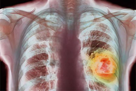 Poorly differentiated lung cancer