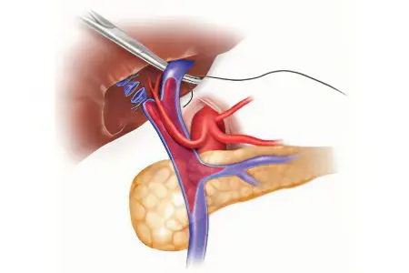 Portal vein thrombosis