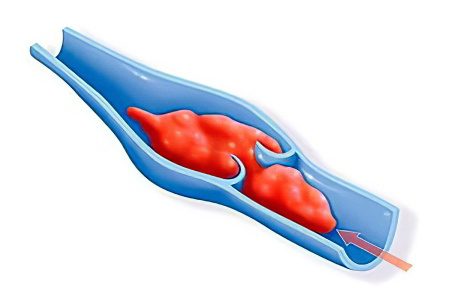 Portal vein thrombosis