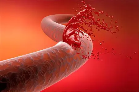 Posthemorrhagic anemia