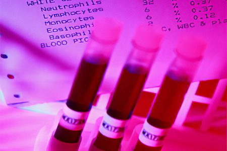 Posthemorrhagic anemia