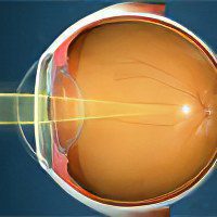 Progressive myopia in children