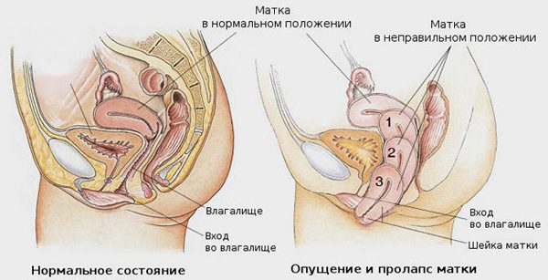 Prolapse of the uterus: causes and treatment