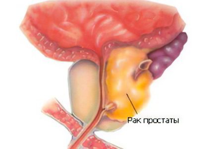 Prostate cancer: symptoms, degrees, stages and treatment