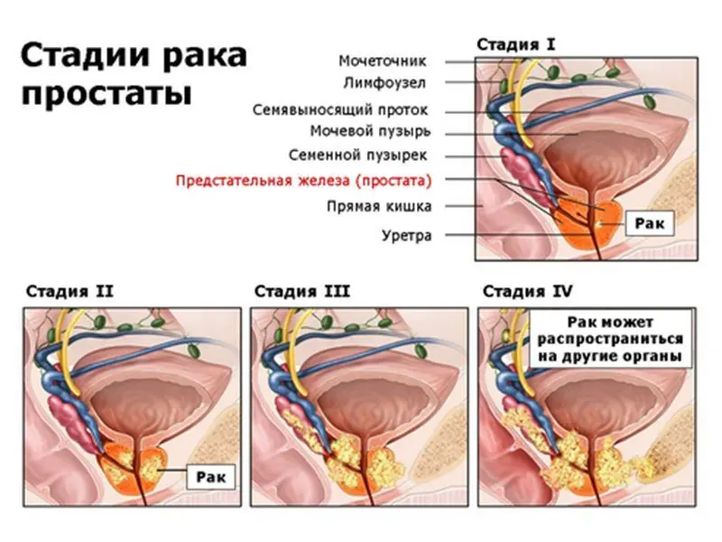 Prostate cancer: symptoms, degrees, stages and treatment