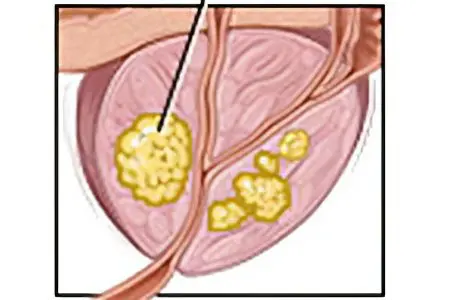 Prostate cancer: symptoms, degrees, stages and treatment