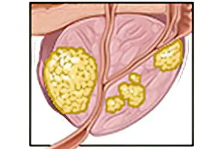 Prostate cancer: symptoms, degrees, stages and treatment