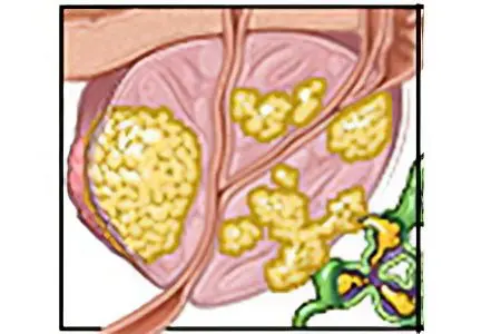 Prostate cancer: symptoms, degrees, stages and treatment