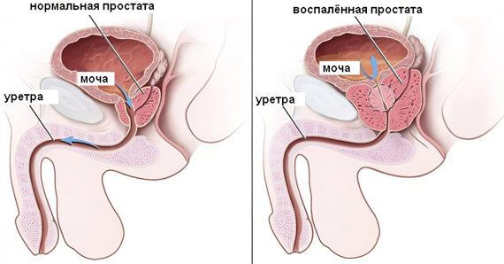 Prostatitis: causes, signs and symptoms