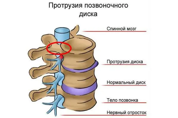 Protrusion of the discs of the lumbar spine