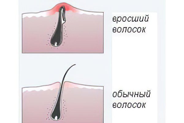 Pseudo-folliculitis &#8211; how to get rid of ingrown hairs?