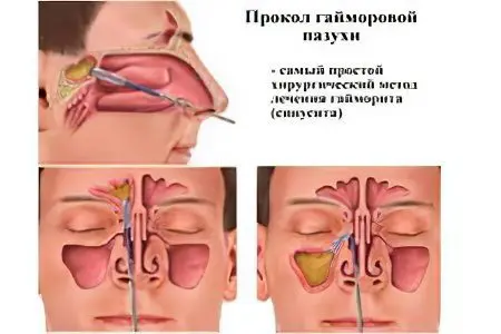 Puncture with sinusitis