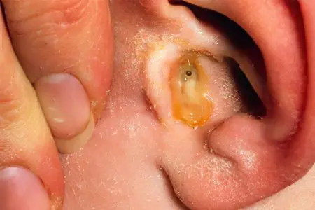 Purulent, catarrhal, exudative and otitis media in children