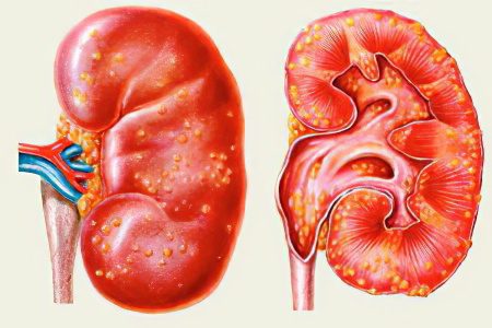 Pyelonephritis: Ursachen, Symptome, Behandlung