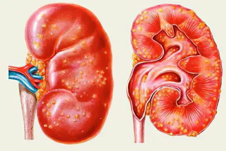 Pyelonephritis: causes, symptoms, treatment