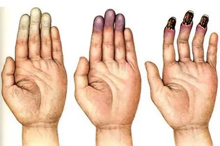 Raynaud&#8217;s disease (syndrome)