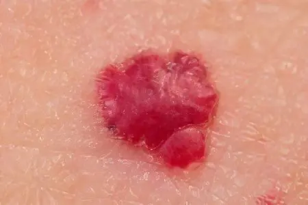 Red moles on the body, causes of appearance