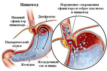 Reflux esophagitis: symptoms and treatments