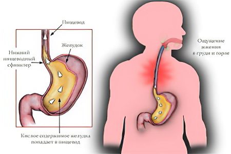 Reflux esophagitis: symptoms and treatments