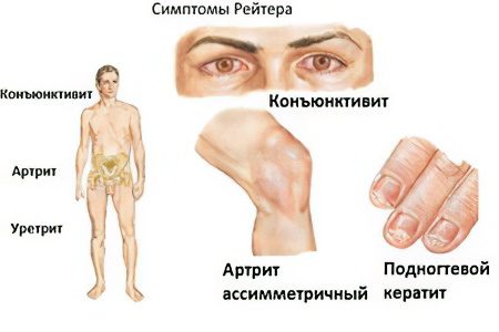 Reiter&#8217;s disease (syndrome) in men and women