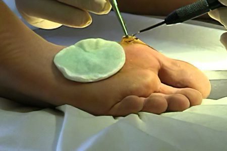 Removal of calluses on the feet