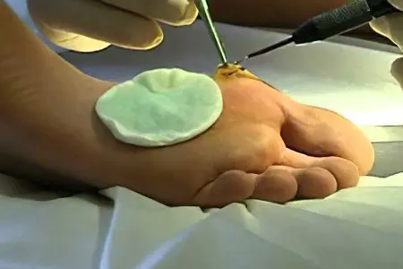 Removal of calluses on the feet