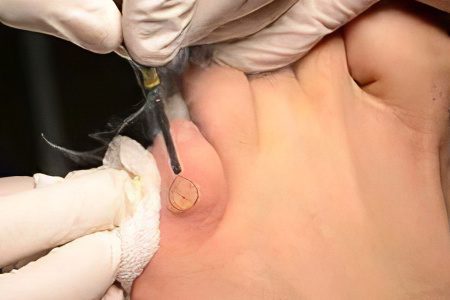 Removal of calluses on the feet