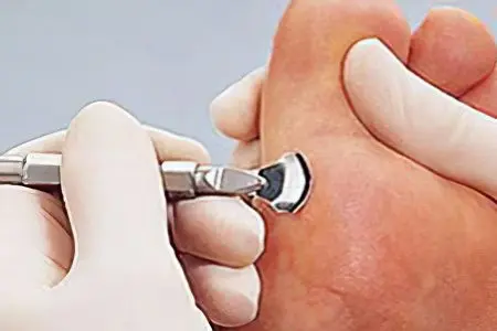 Removal of calluses on the feet