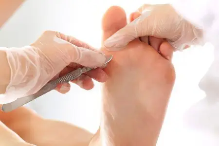 Removal of calluses on the feet