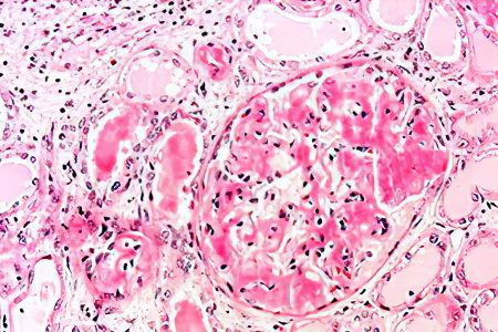 Renal amyloidosis