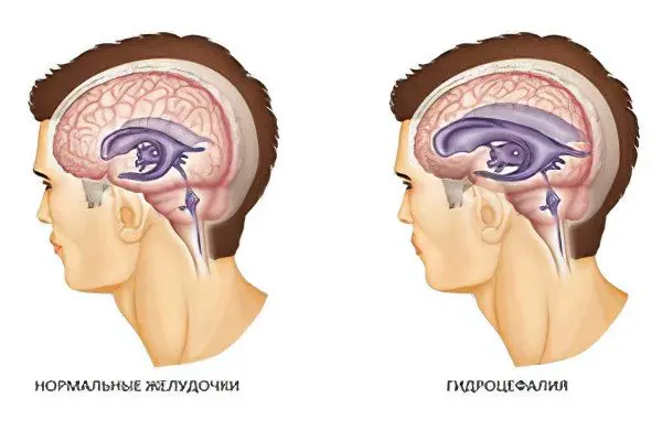 Replacement hydrocephalus