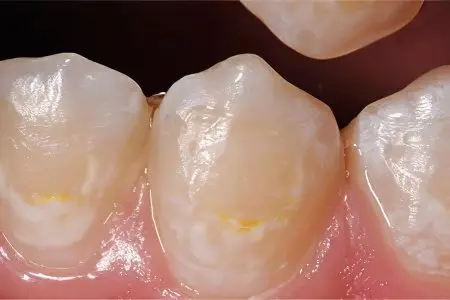 Restoration of tooth enamel